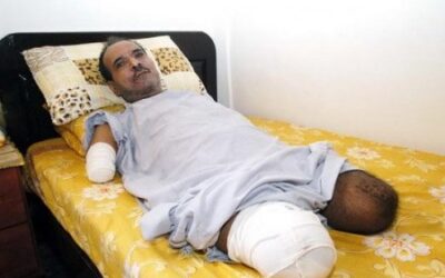 مرض نادر فتك بجسده.. فبات بلا قدمين ويدين خلال عام